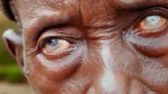 Niger man with river blindness